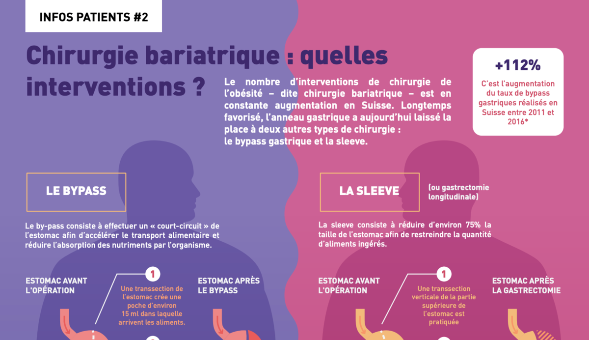 Chirurgie bariatrique - Infographie