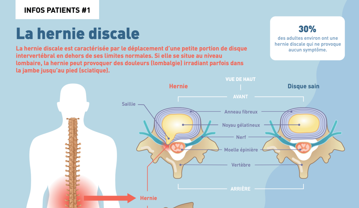 La hernie discale - Infographie